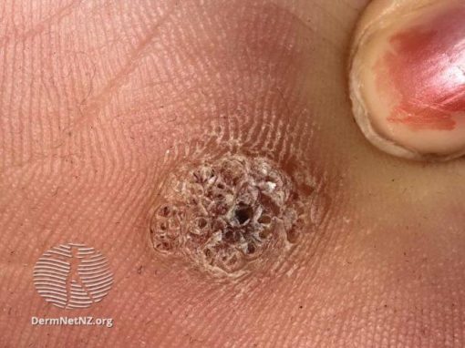 Viral Wart 08 Dermatology And Skin Cancer Center Of Southern Indiana